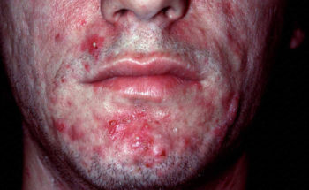 Acne fulminans