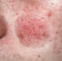 mucinosis follicularis klein Titel
