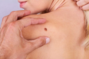 FAQ Huidkanker Breslow dikte melanoom Breslow dikte melanoom