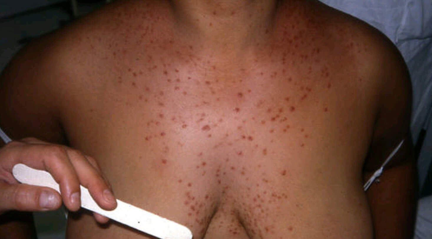 acne rash