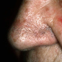Trichostasis-Titel