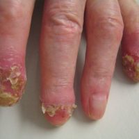 Acrodermatitis van Hallopeau-Titel