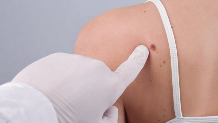 Uit welke moedervlekken ontstaan melanomen ?