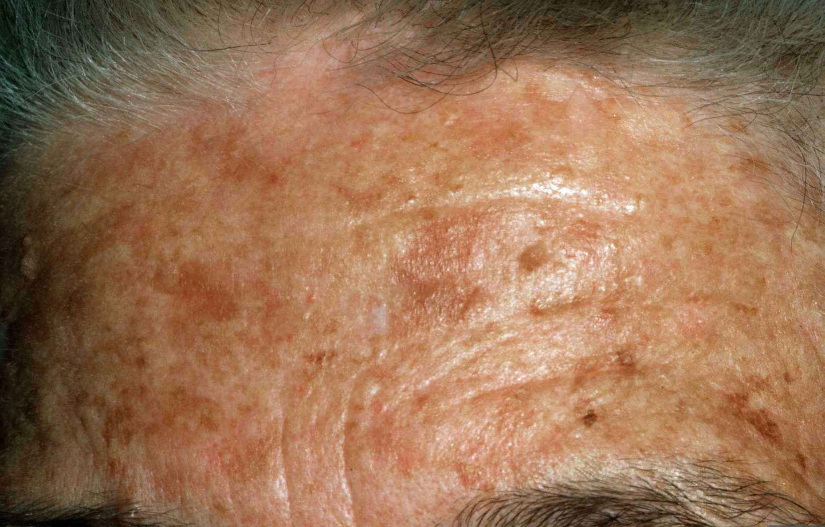 Dermatosis papulosa nigra: bruine-zwarte 'wratjes' gezicht ...