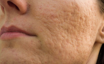 ice pick littekens acne