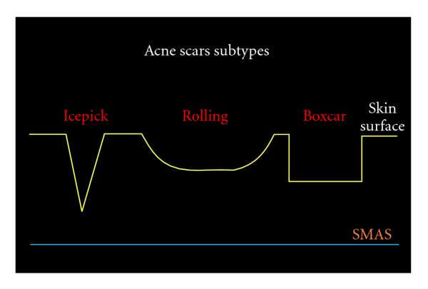 acne littekens soorten