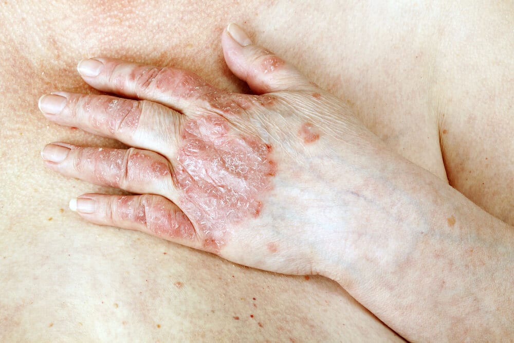 Psoriasis blijkt net zo slecht voor hart en vaten als suikerziekte