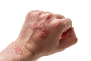 faq-psoriasis-besmettelijk