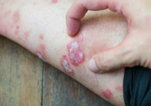 faq-psoriasis-oorzaak