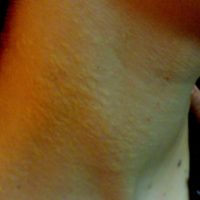 pseudoxanthoma-elasticum-horizontaal