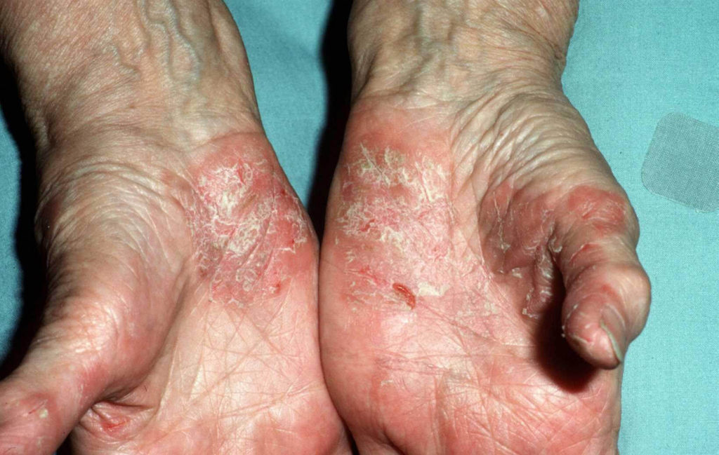 Teleurgesteld Smerig kreupel Psoriasis palmoplantaris / Psoriasis van de handpalmen en voetzolen -  Huidarts.com
