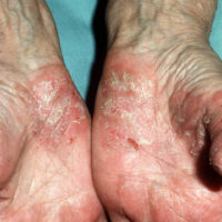 psoriasis-palmoplantaris-titel