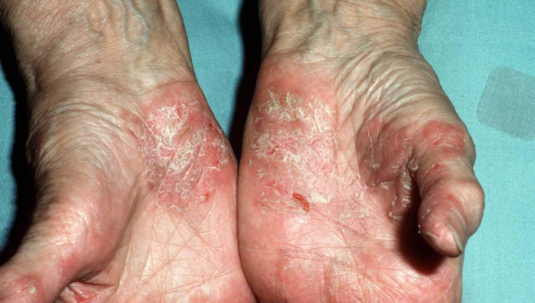 Psoriasis palmoplantaris / Psoriasis van de handpalmen en voetzolen