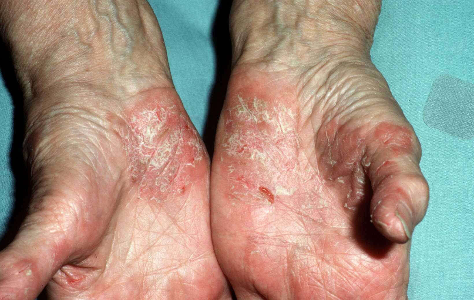 Psoriasis palmoplantaris / van de handpalmen en - Huidarts.com