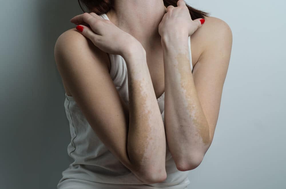 Lichttherapie bij vitiligo