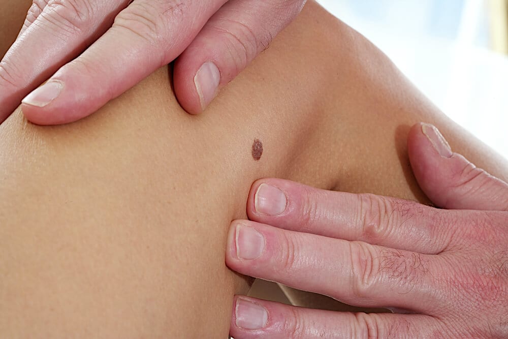 Kan een melanoma in situ toch uitzaaien ?
