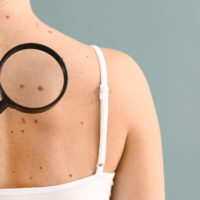 Dermatologist,Examining,Moles,Of,Patient,On,Grey,Background
