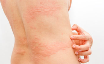Urticaria bij corona