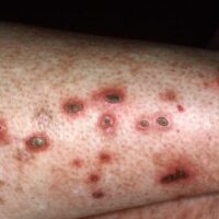 Dematitis artefacta -Titel