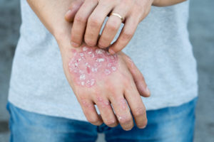 FAQ persoon meerdere psoriasis Psoriasis hand