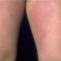 Koude-panniculitis-Titel