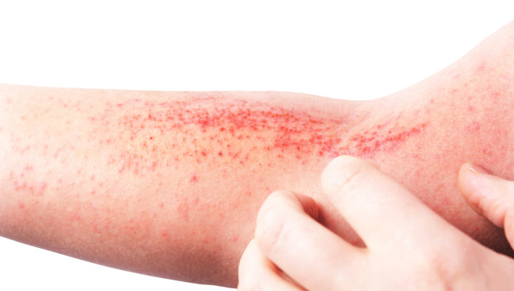 Dupilumab vermindert bijkomende huidinfecties bij atopisch eczeem