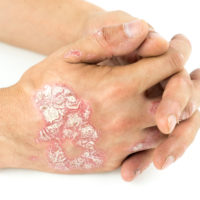 Nieuws 211. Zichtbare afwijkingen van psoriasis psoriasis handruggen
