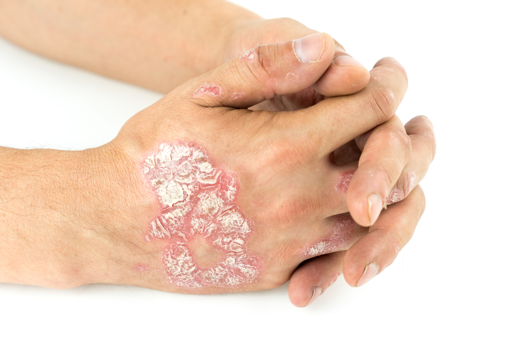 psoriasis handruggen