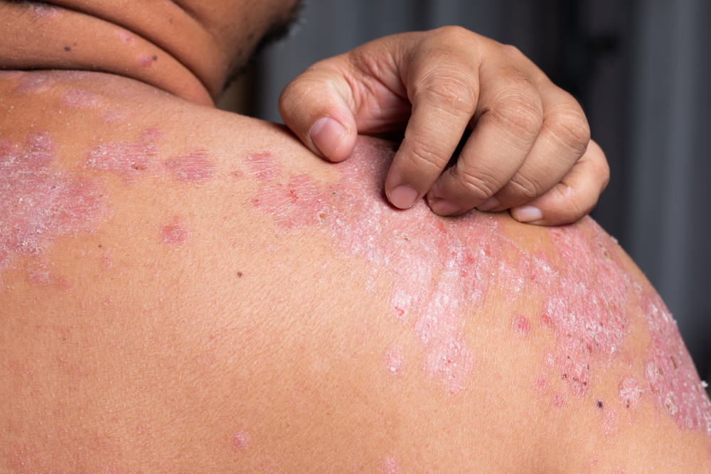 Behandeling met biologicals geeft geen verhoogd risico op kanker