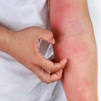 Nieuws 218.Hoge dosis vitamine D eczeem Vitamine D tegen eczeem