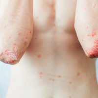 Nieuws 227 Psoriasis verhoogt darmziekten