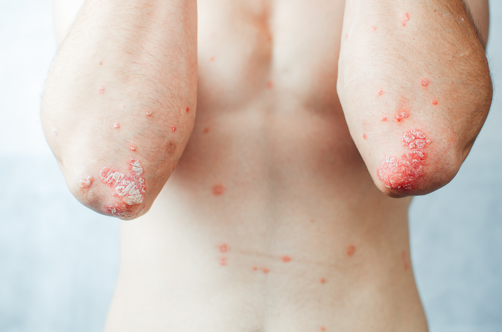 Psoriasis verhoogt het risico op darmziekten