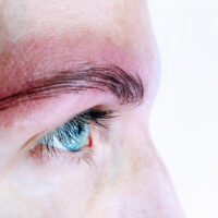 Allergy,Rash,And,Health,Problem.,Skin,Allergy,Eyebrows,Permanent,Makeup.