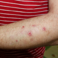 A,Case,Of,Prurigo,Nodularis,In,A,Male.