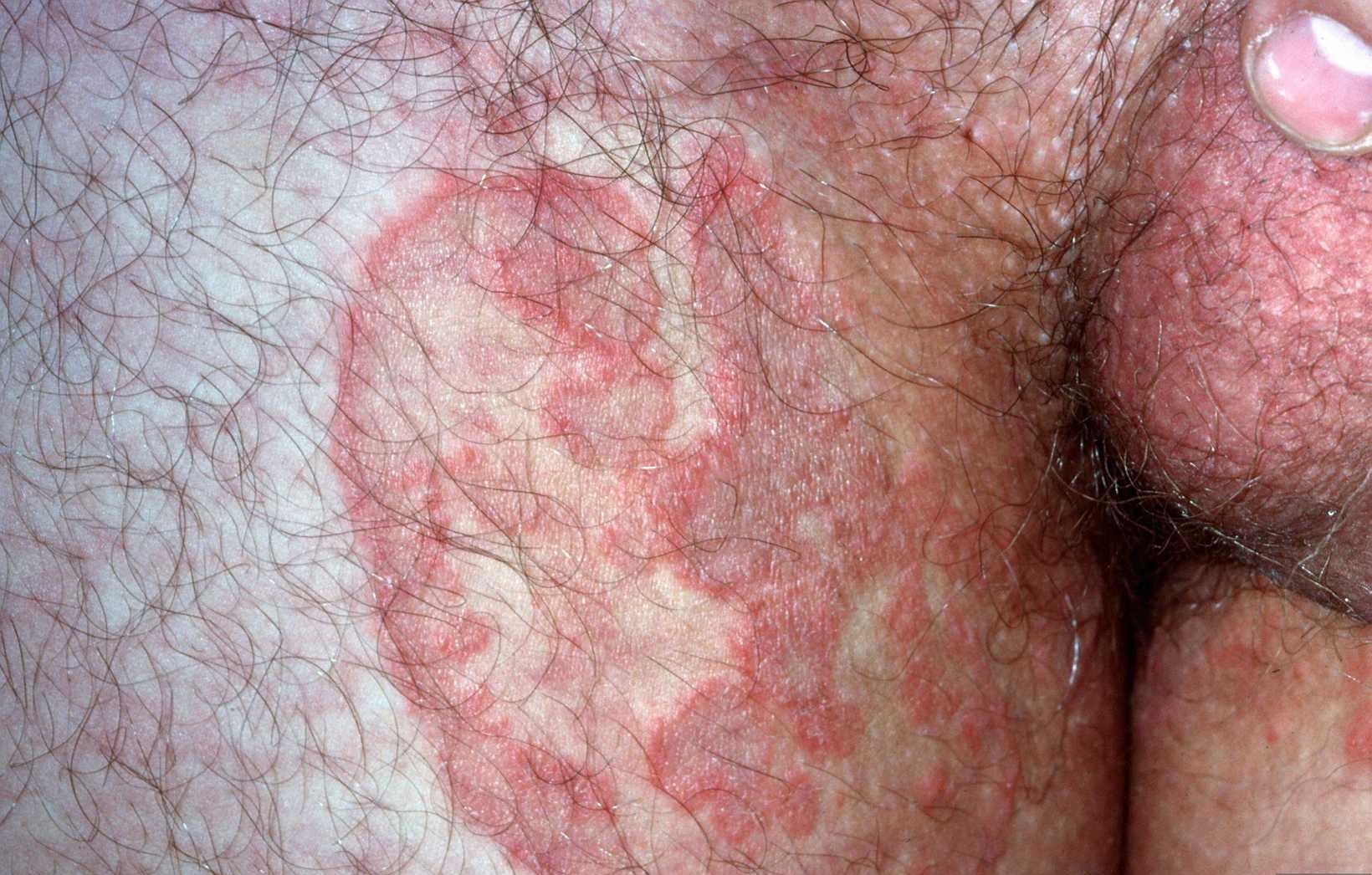 Ringworm liezen
