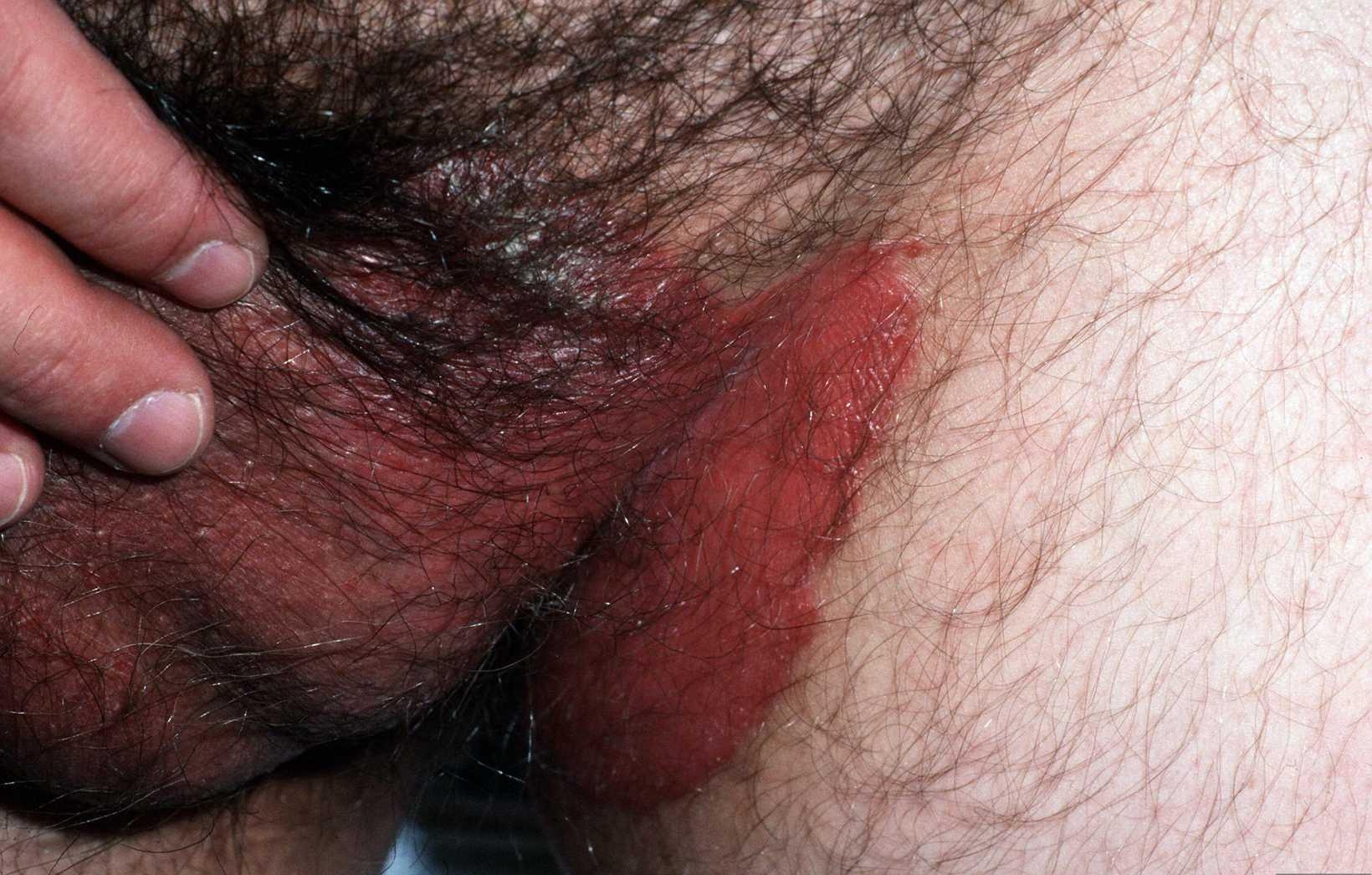 psoriasis liezen