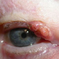 Talgkliercarcinoom oog