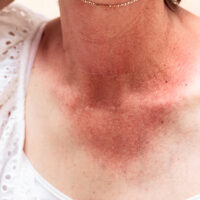 A,Close,Up,And,Front,View,On,The,Severely,Burned